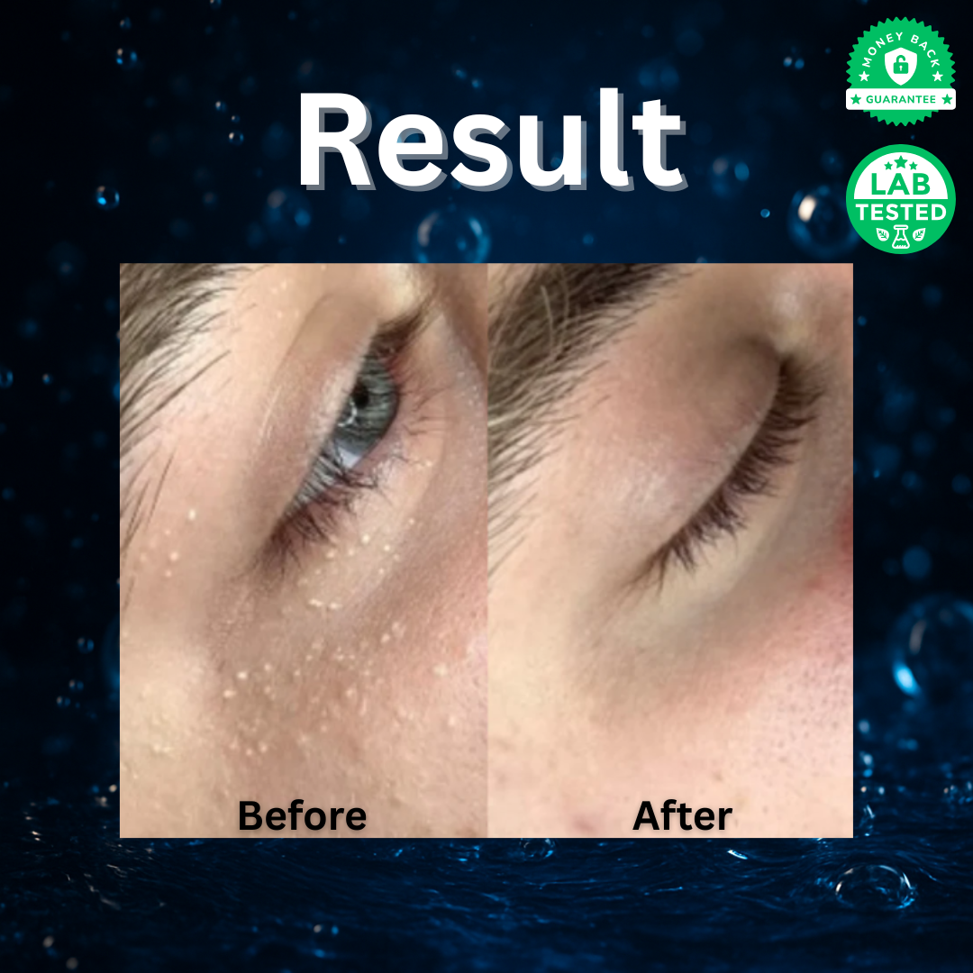 Milia Cleansing Serum™